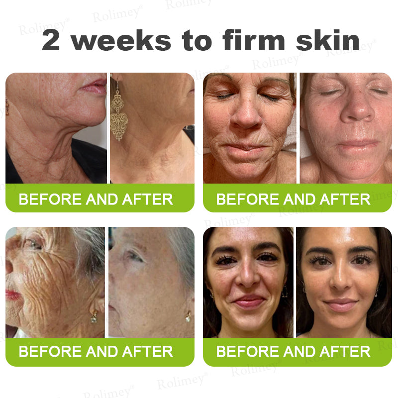 🌟👨‍⚕️Made and shipped from Australia 💫Rolimey® Botox & Vita-A Retinol Shot Wrinkle-Lift Tightening cream - Last Day Promotion 70% OFF