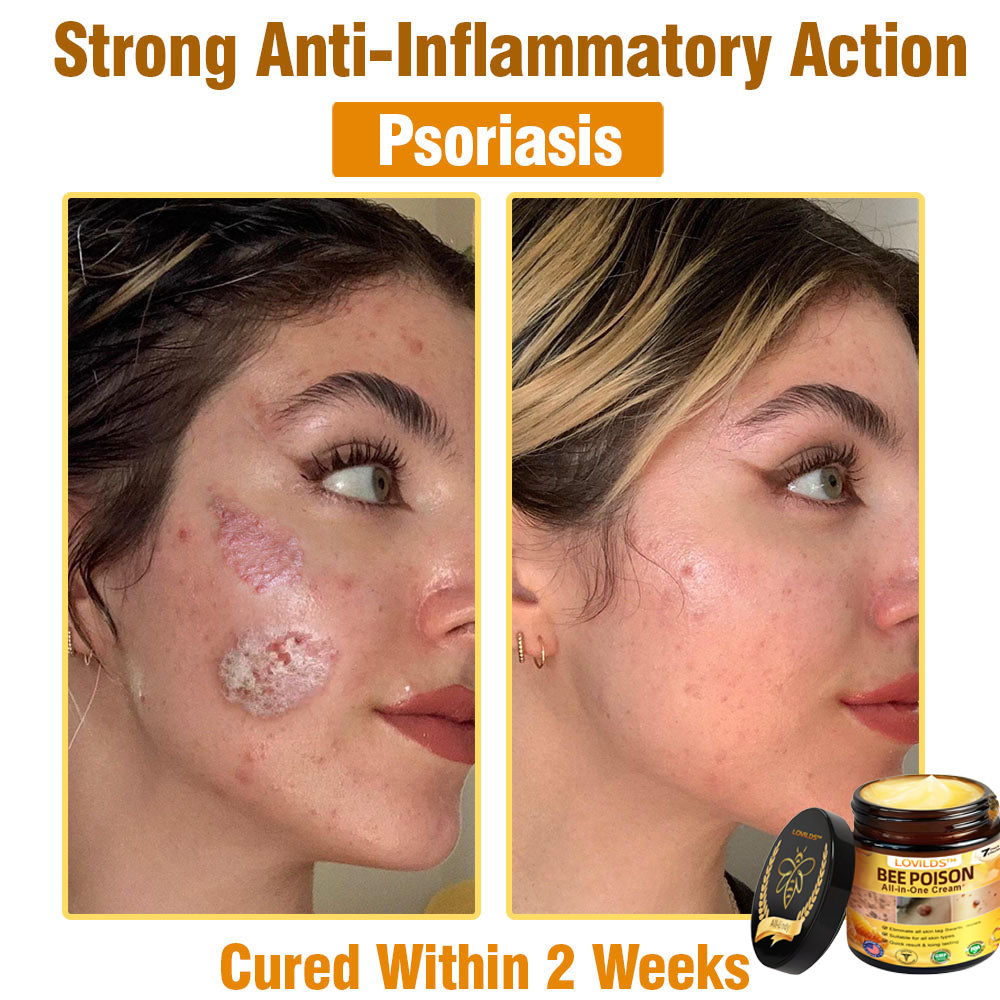 LOVILDS™ Bee Poison All-in-One Cream US Dermatologist Approved.