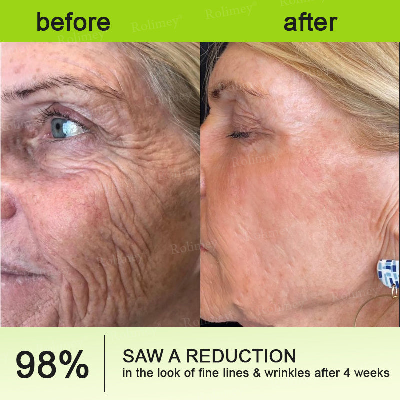 🌟👨‍⚕️Made and shipped from Australia 💫Rolimey® Botox & Vita-A Retinol Shot Wrinkle-Lift Tightening cream - Last Day Promotion 70% OFF