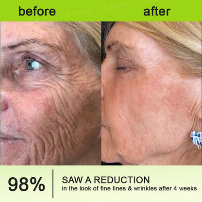 🌟👨‍⚕️Made and shipped from Australia 💫Rolimey® Botox & Vita-A Retinol Shot Wrinkle-Lift Tightening cream - Last Day Promotion 70% OFF