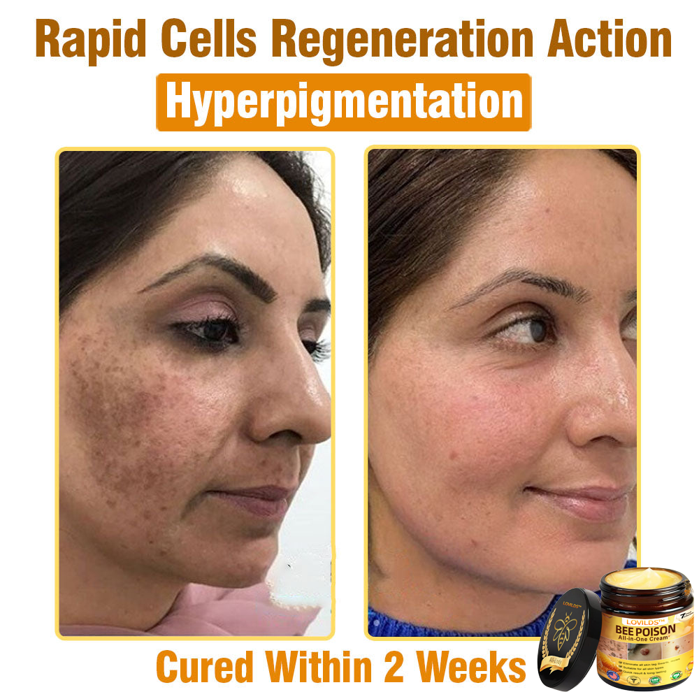 LOVILDS™ Bee Poison All-in-One Cream US Dermatologist Approved.