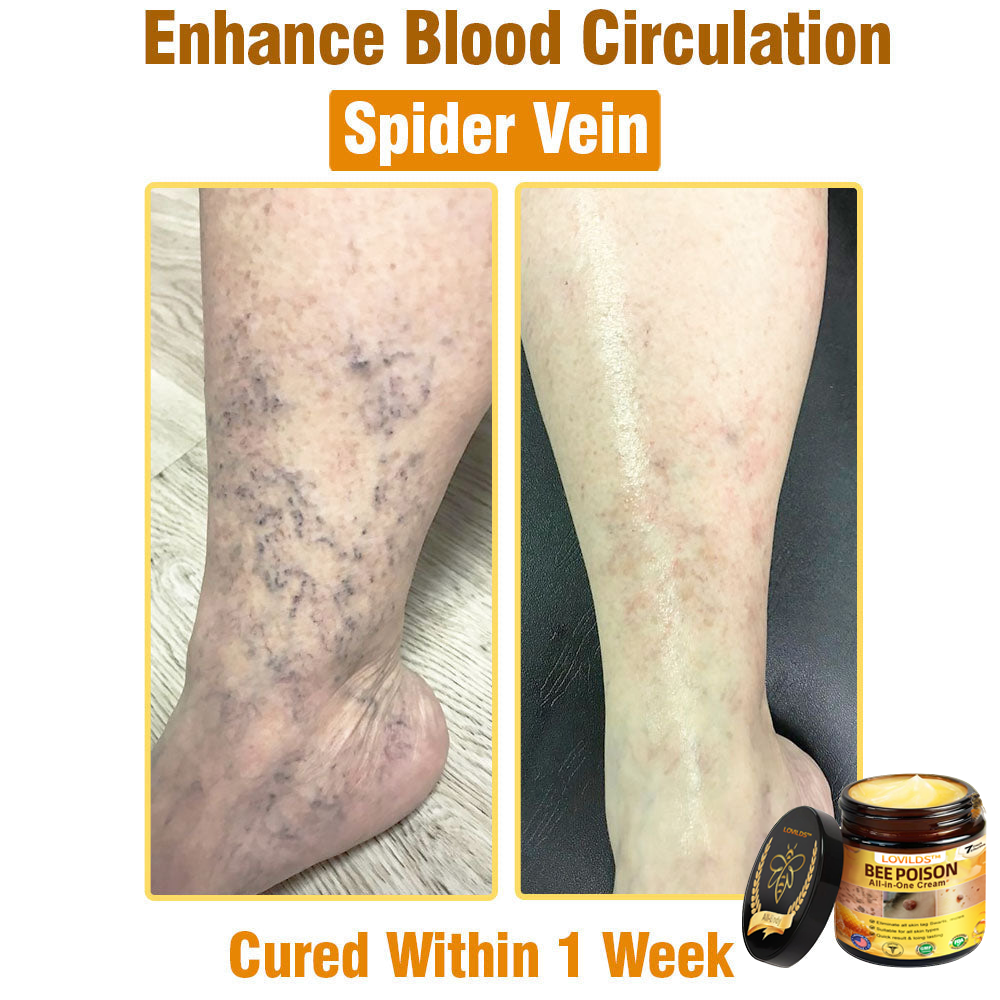 LOVILDS™ Bee Poison All-in-One Cream US Dermatologist Approved.