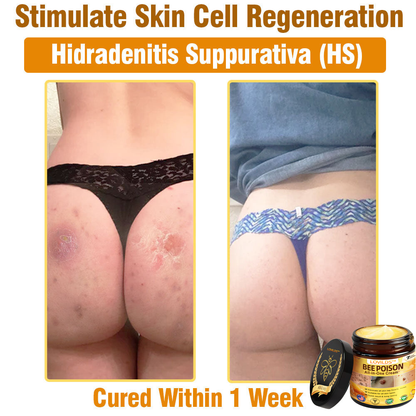 LOVILDS™ Bee Poison All-in-One Cream US Dermatologist Approved.