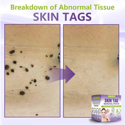 NESLEMY® Soluble Microneedle Botanical Skin Tag Removal Patch
