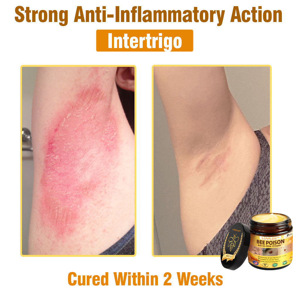 LOVILDS™ Bee Poison All-in-One Cream US Dermatologist Approved.