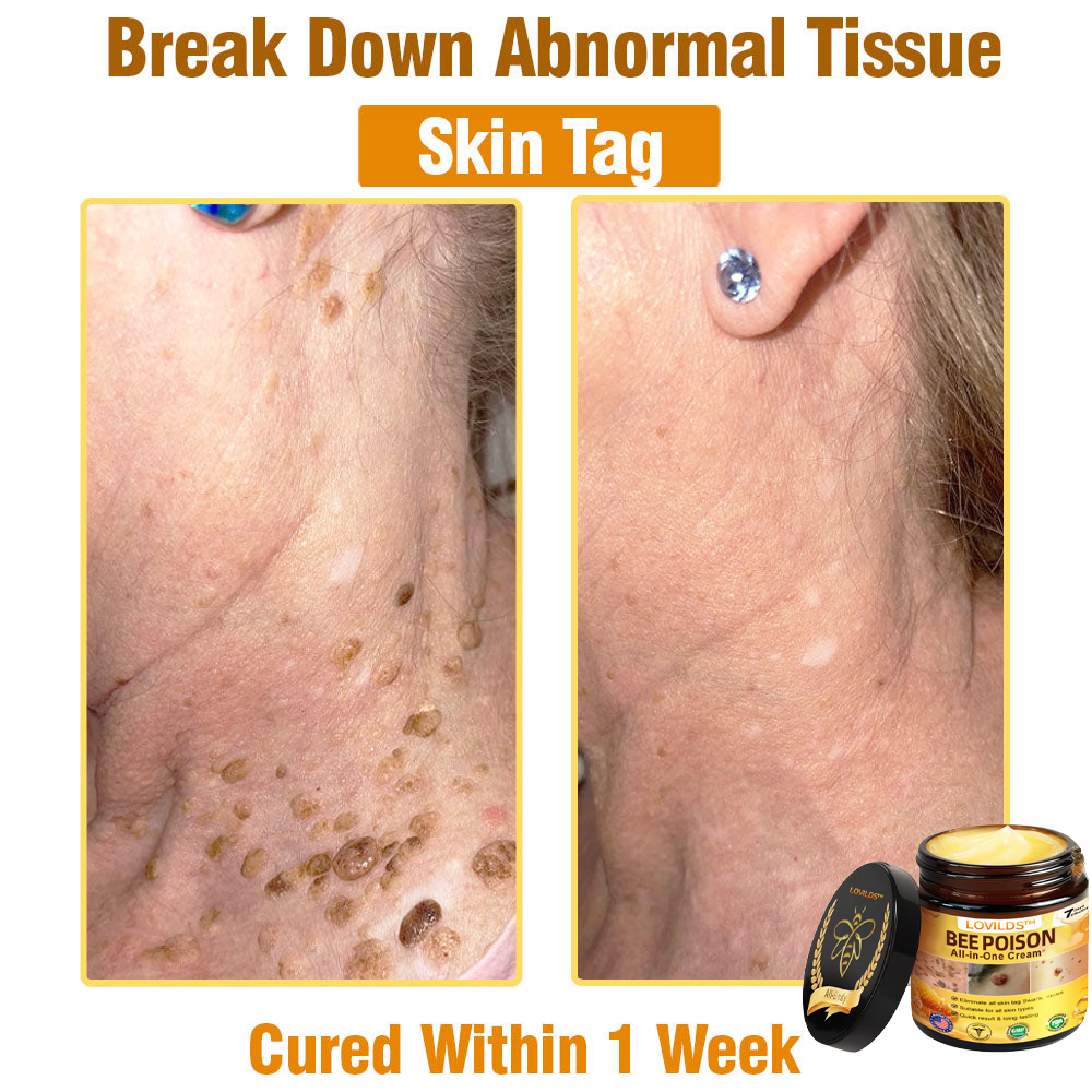 LOVILDS™ Bee Poison All-in-One Cream US Dermatologist Approved.