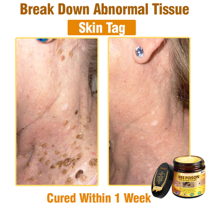 LOVILDS™ Bee Poison All-in-One Cream US Dermatologist Approved.