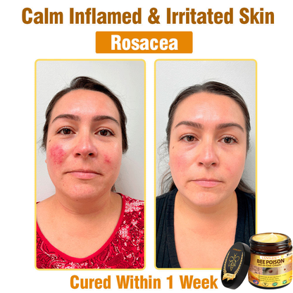 LOVILDS™ Bee Poison All-in-One Cream US Dermatologist Approved.